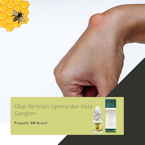 Jual Obat Penghancur Lipoma Obat Oles Penghilang Benjolan Di Tangan