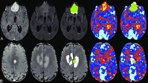 Representative Axial Slices From A 77 Year Old Male Patient A With A