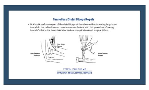 Tunnelless Distal Biceps Repair Steven Chudik Md