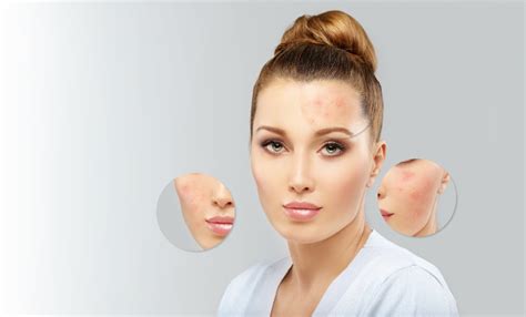 HydraFacial For Acne Prone Skin Clear And Prevent Breakouts