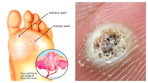 Warts - Chicago Foot Care Clinic