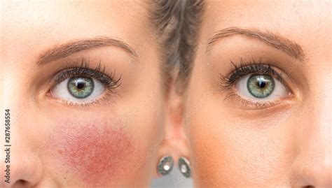 Before And After Results Of Brimonidine Tartrate Treatment For Rosacea