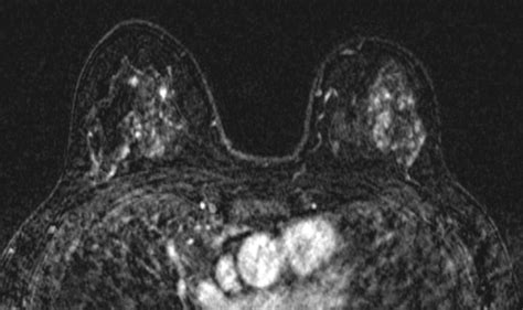 Hormonal Effects On Breast Density Fibroglandular Tissue And