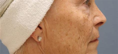 Microneedling Rf Pixel Form Md Aesthetics Mission Viejo Medical