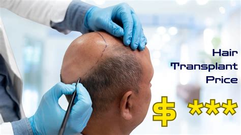 Hair Transplant Price In Malaysia