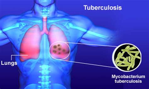 Ciencias Naturales Ceuja La Tuberculosis