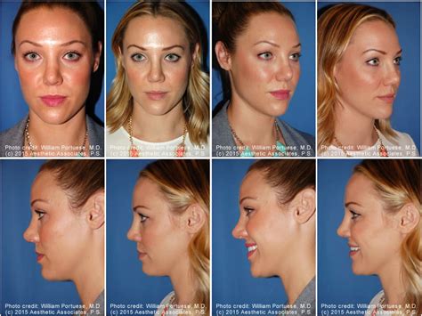 Rhinoplasty And Chin Implant Before And After Rhinoplasty Patients