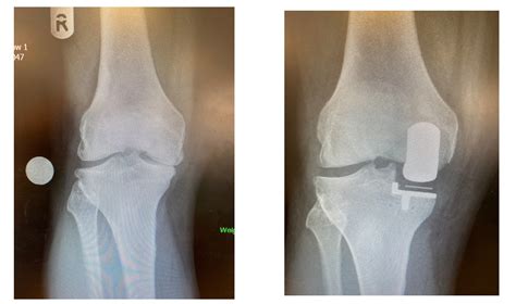 New Knee Replacement Options