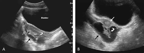 A Sagittal And B Transverse Pelvic Ultrasound Images Showing A