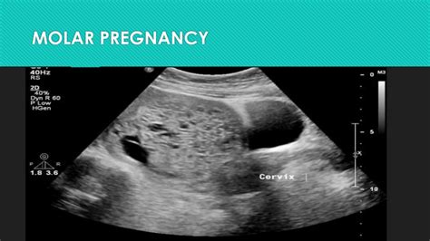 Ppt Transvaginal Ultrasound Powerpoint Presentation Free Download