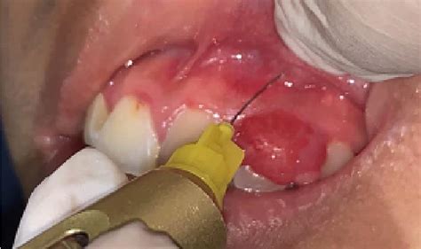 Figure 1 From Management Of Fibrous Epulis Of Anterior Maxillary Teeth