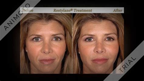 Corya Aesthetics And Wellness Cosmetic Injectables And Dermal Fillers