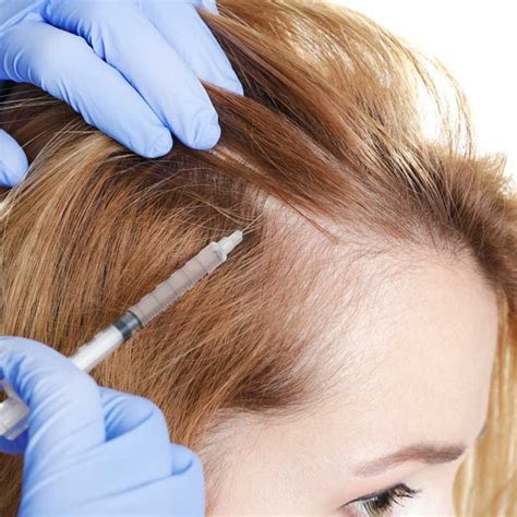 Alopecia Area Penyebab Jenis Gejala Dan Pengobatan