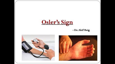 Osler S Sign Dr Akif Baig YouTube