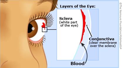 Subconjunctival Hemorrhage | Dayton Children's Hospital