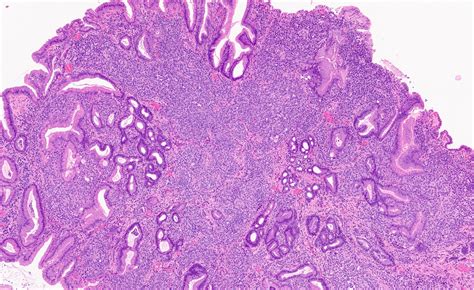 Incidental Finding In The Stomach During An Endoscopy For Dyspepsia