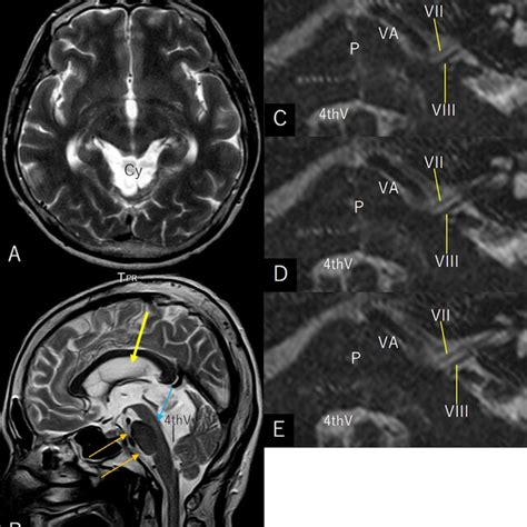 Axial A And Sagittal B T2 Weighted Mri Showing Reduction Of The