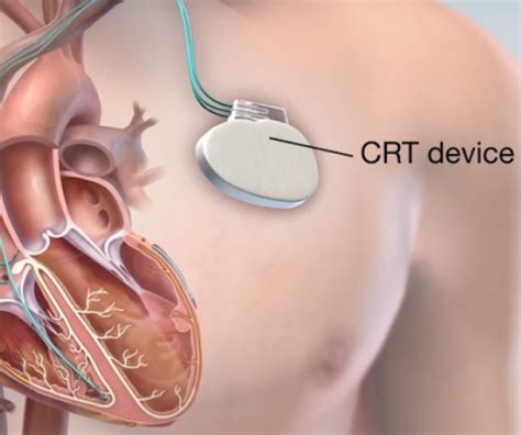 Cardiac Resynchronisation Therapy At Dr Karthigesan Clinic