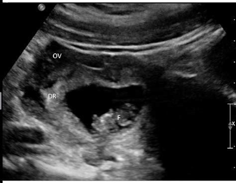 Ch Sonographic Assessment Of The Ectopic Pregnancy Flashcards Quizlet