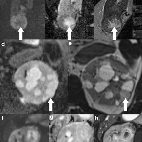 CT and MRI imaging characteristics of common renal masses | Download Table