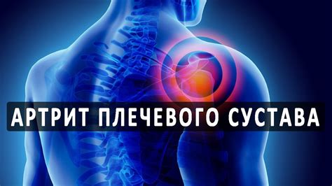 Что нужно знать об артрите плечевого сустава - YouTube