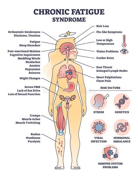 Syndrome De Fatigue Chronique Avec Les Sympt Mes Et Les Facteurs De