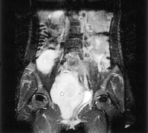 Magnetic Resonance Imaging T2 Weighted Image Shows A Teardrop Shaped