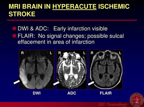 PPT UPDATE IN ACUTE ISCHEMIC STROKE MANAGEMENT PowerPoint