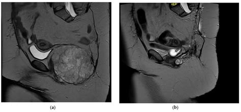 A Sagittal T2 Mri Demonstrating A Recurrent Chordoma In The Pelvic Download Scientific