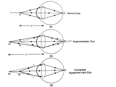 Make A Diagram To Show How Hypermetropia Is Corrected The Near Point