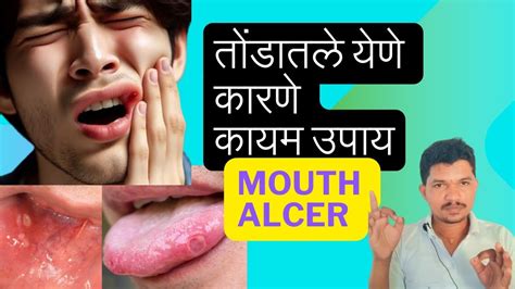 तोंडातले येणे त्याची कारणे व उपाय Mouth Ulcers Causes And Remedies