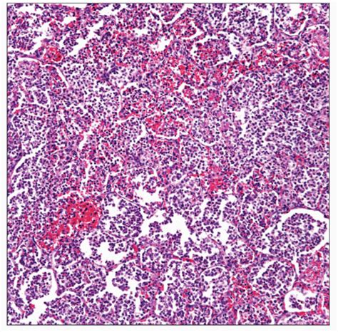 Klebsiella Pneumonia Basicmedical Key