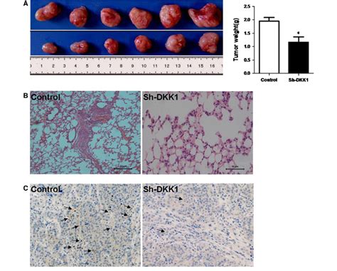 Knockdown Of Dkk1 Inhibited Growth Metastasis And Angiogenesis Of Hcc