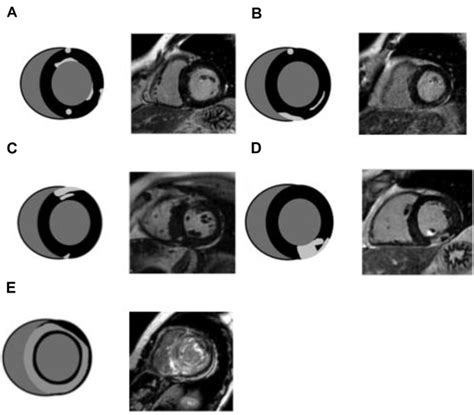 The Prognostic Value Of Late Gadolinium Enhancement In Nonischemic