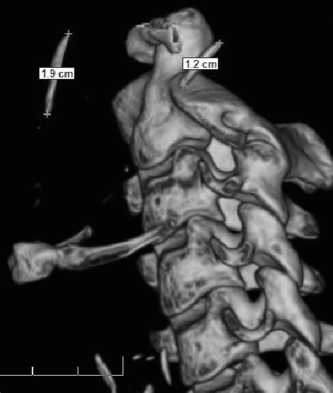 3D-CT scan image showing bilateral calcification of the stylohyoid... | Download Scientific Diagram