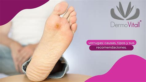 Verrugas Causas Tipos Y Recomendaciones DERMOVITALL