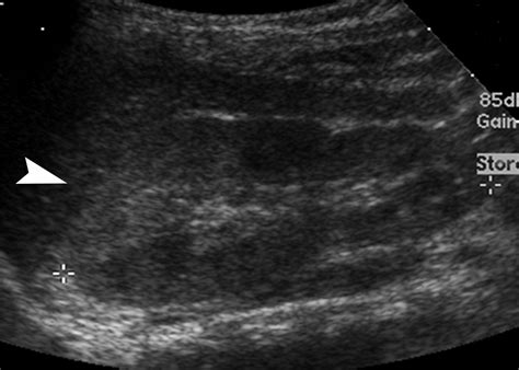 Pyelonephritis Radiologic Pathologic Review Radiographics