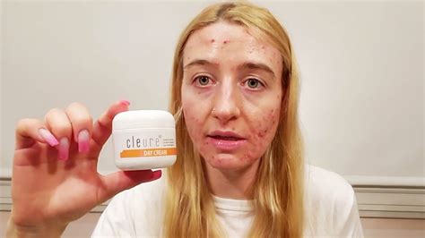 Week Journey On Accutane Side Effects Tips And Product