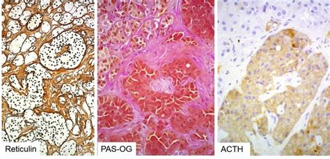 Pathology And Pathogenesis Of Pituitary Adenomas And Other Sellar