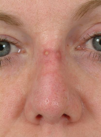 Skin Atrophy Nose