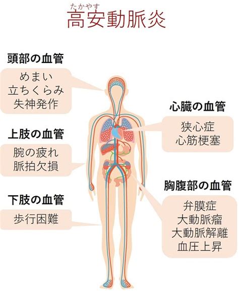 世界初：高安動脈炎の病因となるタンパク質を同定 プレスリリース・研究成果 東北大学 Tohoku University