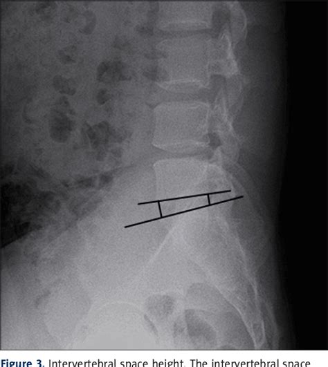 Figure From Risk Factors For Recurrent L S Disc Herniation After