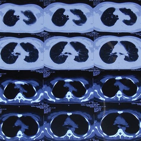 Chest Computed Tomography Scan Before Treatment Download Scientific