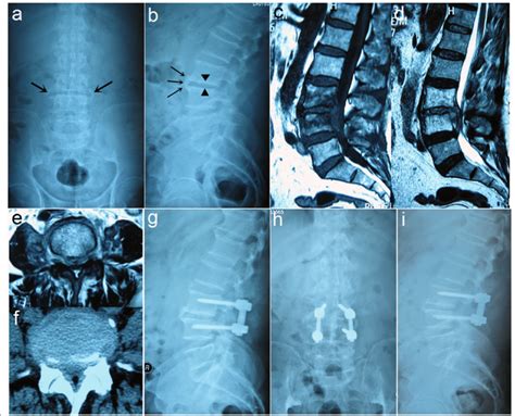 A 69 Year Old Male Present With L3 L4 Spinal Brucellosis A