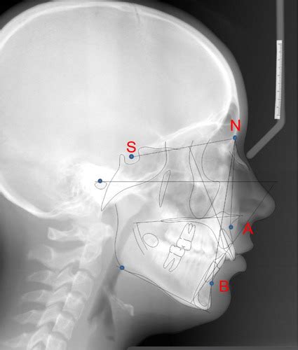 Cephalometric Radiographs In Ortho Flashcards Quizlet