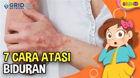 Cara Cara Mengatasi Biduran Di Tubuh Youtube