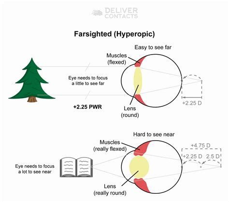 Hyperopia Farsighted Causes Signs And Treatment