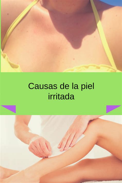 Como Curar La Piel Irritada Con Remedios Naturales Y Caseros