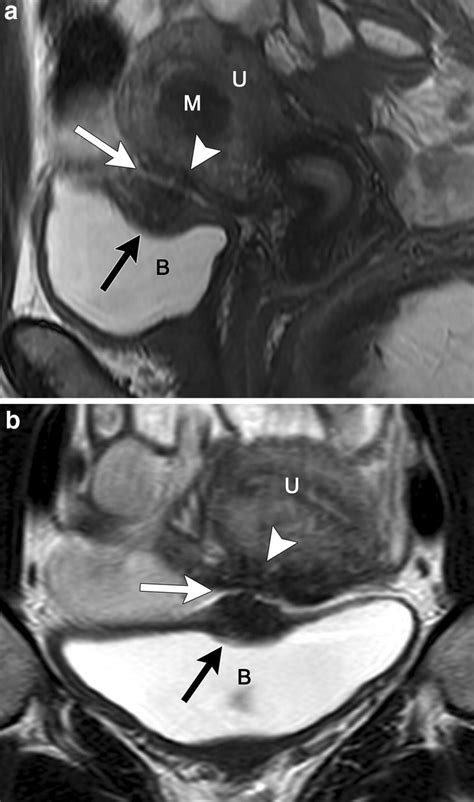 Bladder Deep Infiltrating Endometriosis A Sagittal T2 And B Coronal