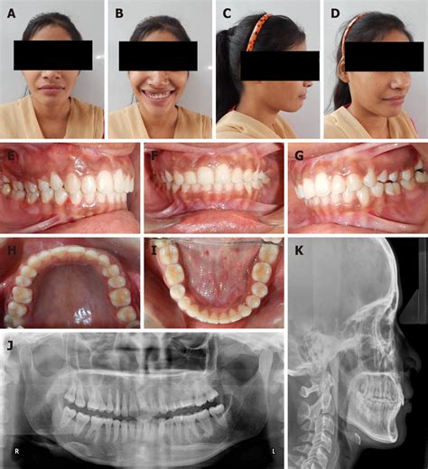 Fibrous Dysplasia Of Maxilla